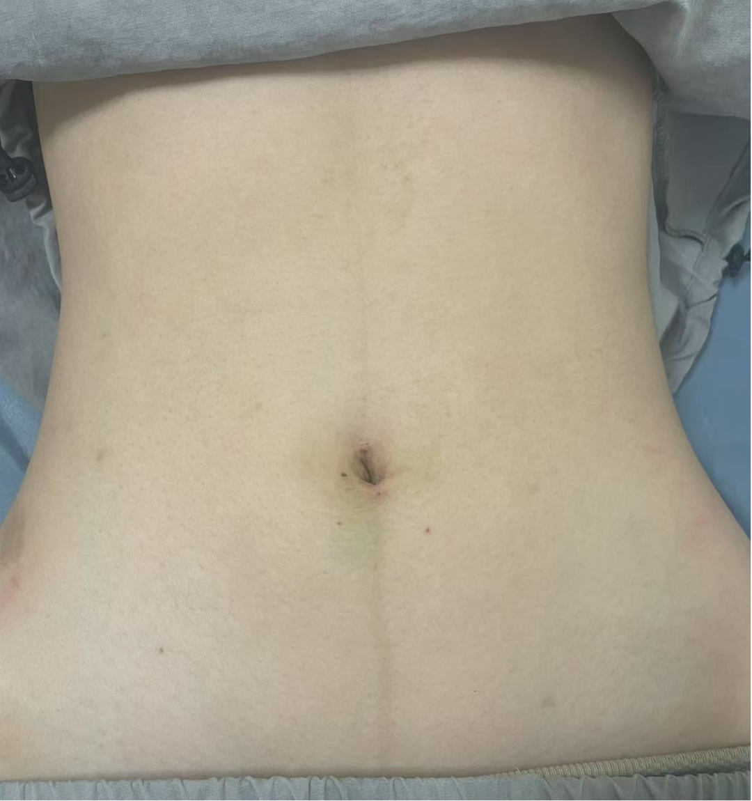 怎么制造手术钩针告别“疤”恼！微创美学新选择——钩针辅助下腹腔镜单位置切口阑尾切除术（HLA）_https://www.jmylbn.com_新闻资讯_第4张