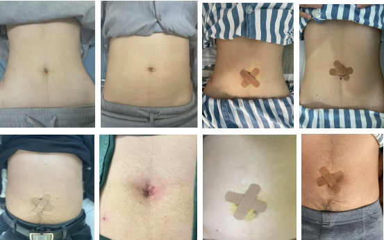 怎么制造手术钩针告别“疤”恼！微创美学新选择——钩针辅助下腹腔镜单位置切口阑尾切除术（HLA）_https://www.jmylbn.com_新闻资讯_第6张