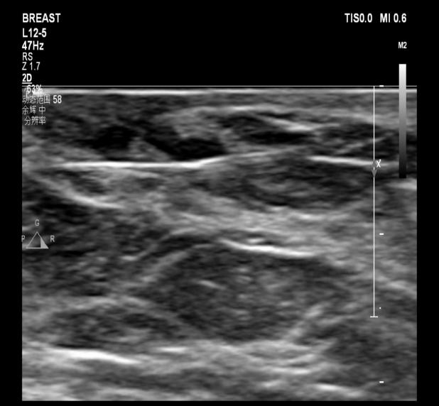 为什么要定位针 乳腺【苏州市中医医院丨聚焦专科】小钩针，大作用，让乳腺小结节无处可逃_https://www.jmylbn.com_新闻资讯_第4张