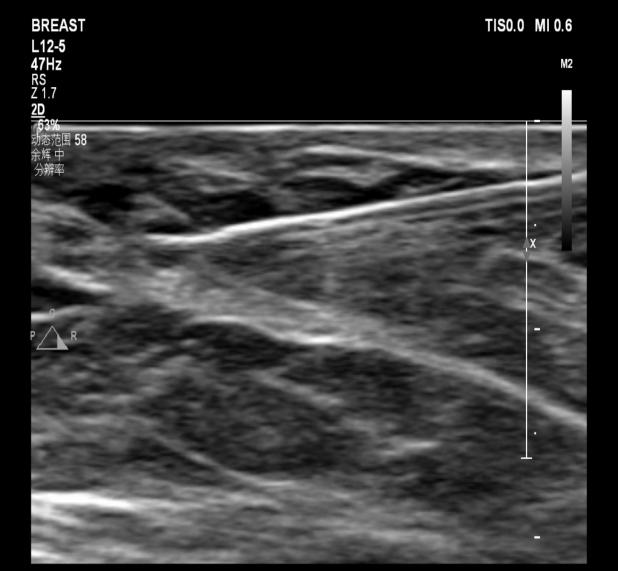 为什么要定位针 乳腺【苏州市中医医院丨聚焦专科】小钩针，大作用，让乳腺小结节无处可逃_https://www.jmylbn.com_新闻资讯_第3张