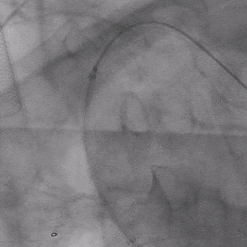 泥鳅导丝怎么用郎德海、胡松杰教授团队：浙江省首例使用0.035″泥鳅导丝软头柔性破壁原位重建LSA_https://www.jmylbn.com_新闻资讯_第20张