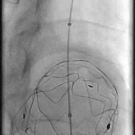 泥鳅导丝怎么用郎德海、胡松杰教授团队：浙江省首例使用0.035″泥鳅导丝软头柔性破壁原位重建LSA_https://www.jmylbn.com_新闻资讯_第17张