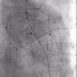 泥鳅导丝怎么用郎德海、胡松杰教授团队：浙江省首例使用0.035″泥鳅导丝软头柔性破壁原位重建LSA_https://www.jmylbn.com_新闻资讯_第19张