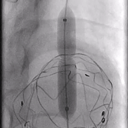 泥鳅导丝怎么用郎德海、胡松杰教授团队：浙江省首例使用0.035″泥鳅导丝软头柔性破壁原位重建LSA_https://www.jmylbn.com_新闻资讯_第18张
