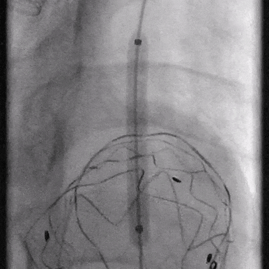 泥鳅导丝怎么用郎德海、胡松杰教授团队：浙江省首例使用0.035″泥鳅导丝软头柔性破壁原位重建LSA_https://www.jmylbn.com_新闻资讯_第16张