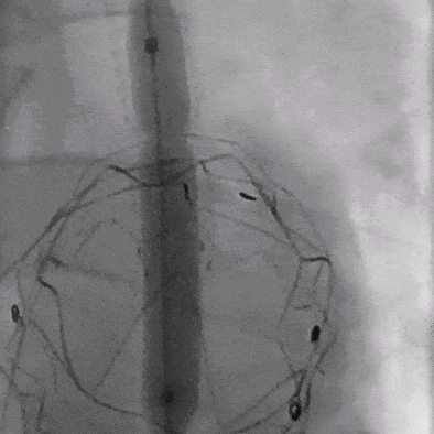 泥鳅导丝怎么用郎德海、胡松杰教授团队：浙江省首例使用0.035″泥鳅导丝软头柔性破壁原位重建LSA_https://www.jmylbn.com_新闻资讯_第22张