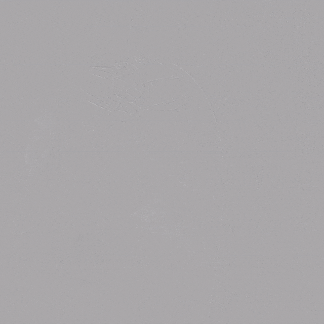 泥鳅导丝怎么用郎德海、胡松杰教授团队：浙江省首例使用0.035″泥鳅导丝软头柔性破壁原位重建LSA_https://www.jmylbn.com_新闻资讯_第13张