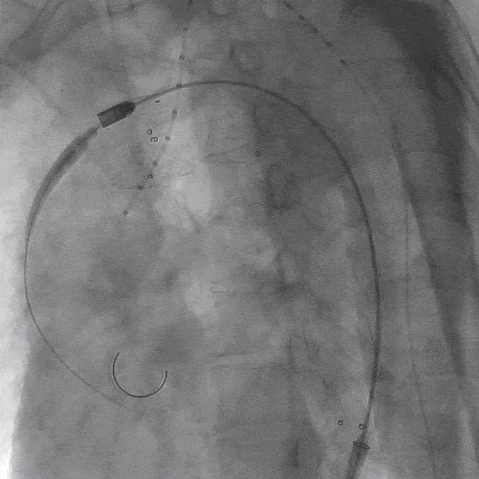 泥鳅导丝怎么用郎德海、胡松杰教授团队：浙江省首例使用0.035″泥鳅导丝软头柔性破壁原位重建LSA_https://www.jmylbn.com_新闻资讯_第12张