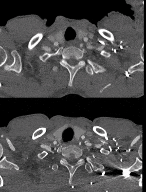 泥鳅导丝怎么用郎德海、胡松杰教授团队：浙江省首例使用0.035″泥鳅导丝软头柔性破壁原位重建LSA_https://www.jmylbn.com_新闻资讯_第27张