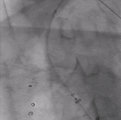 泥鳅导丝怎么用郎德海、胡松杰教授团队：浙江省首例使用0.035″泥鳅导丝软头柔性破壁原位重建LSA_https://www.jmylbn.com_新闻资讯_第21张