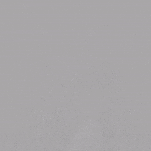 泥鳅导丝怎么用郎德海、胡松杰教授团队：浙江省首例使用0.035″泥鳅导丝软头柔性破壁原位重建LSA_https://www.jmylbn.com_新闻资讯_第10张