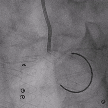 泥鳅导丝怎么用郎德海、胡松杰教授团队：浙江省首例使用0.035″泥鳅导丝软头柔性破壁原位重建LSA_https://www.jmylbn.com_新闻资讯_第14张