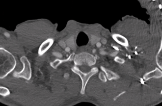 泥鳅导丝怎么用郎德海、胡松杰教授团队：浙江省首例使用0.035″泥鳅导丝软头柔性破壁原位重建LSA_https://www.jmylbn.com_新闻资讯_第4张