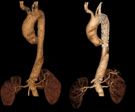 泥鳅导丝怎么用郎德海、胡松杰教授团队：浙江省首例使用0.035″泥鳅导丝软头柔性破壁原位重建LSA_https://www.jmylbn.com_新闻资讯_第26张