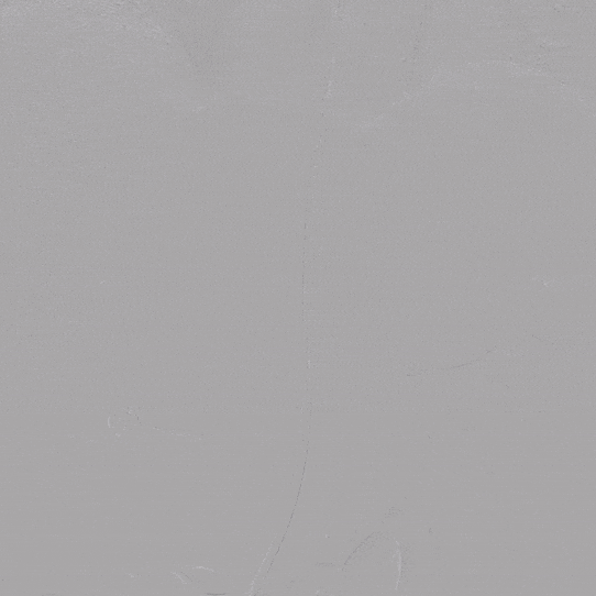 泥鳅导丝怎么用郎德海、胡松杰教授团队：浙江省首例使用0.035″泥鳅导丝软头柔性破壁原位重建LSA_https://www.jmylbn.com_新闻资讯_第24张