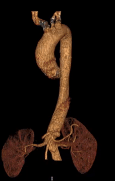 泥鳅导丝怎么用郎德海、胡松杰教授团队：浙江省首例使用0.035″泥鳅导丝软头柔性破壁原位重建LSA_https://www.jmylbn.com_新闻资讯_第3张