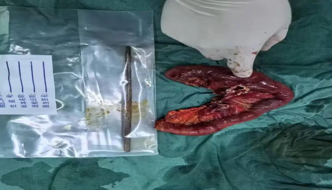 大爷误吞20cm筷子