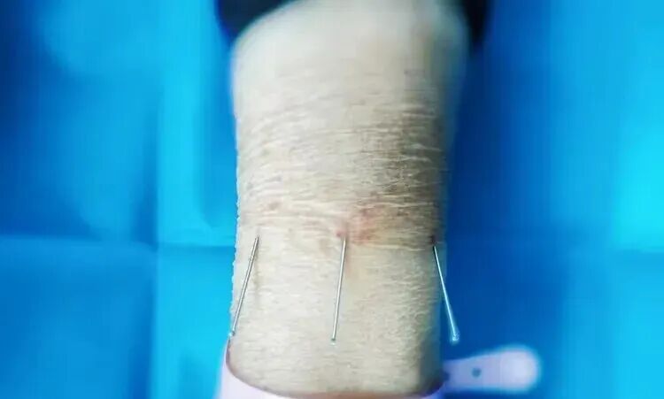 导什么针什么作用【医问医答】一针见效，无痛祛疾｜揭秘中医神奇疗法“腕踝针”_https://www.jmylbn.com_新闻资讯_第3张