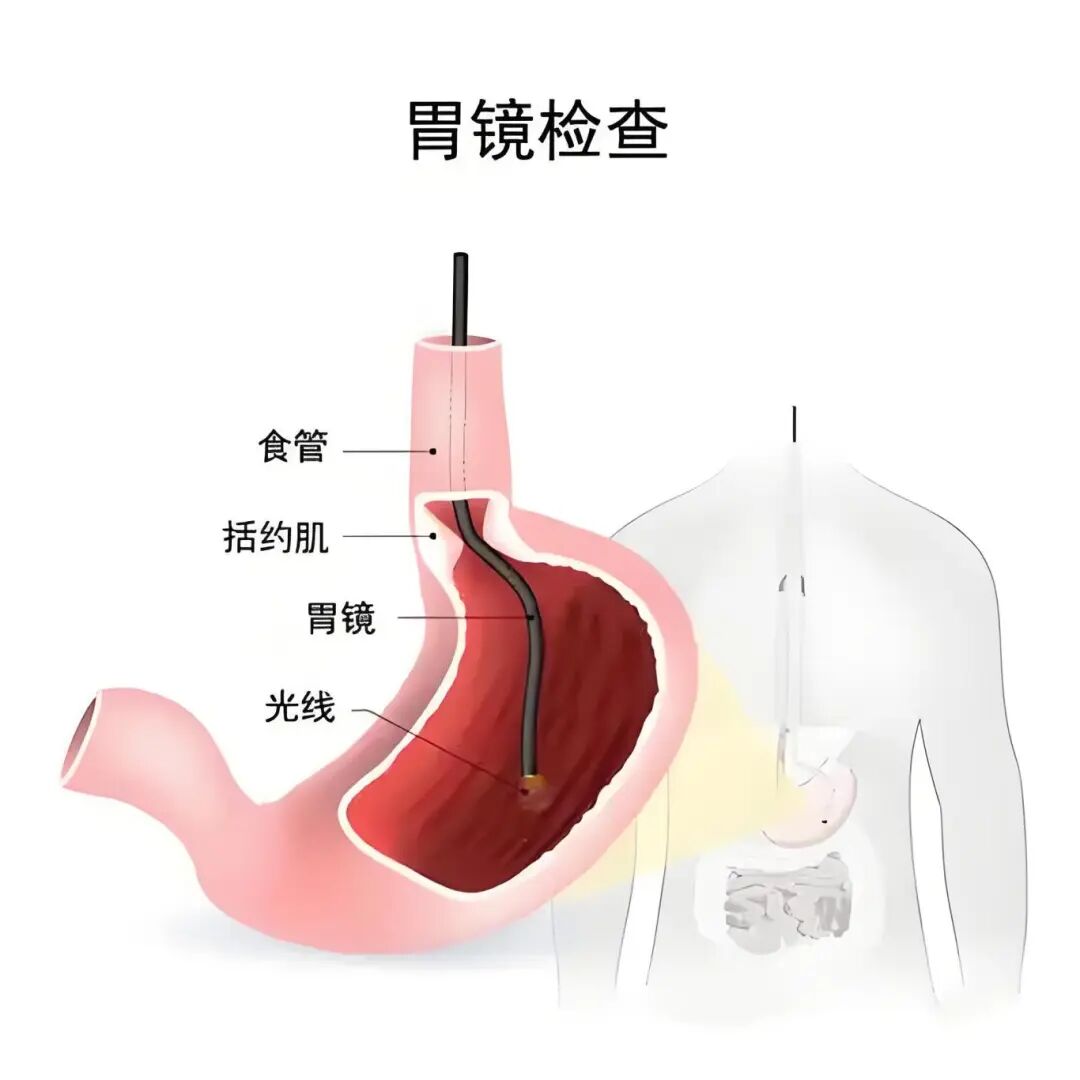人喝活检怎么急救【消化内科】胃镜恐惧急救手册：这3类人再怕也要做_https://www.jmylbn.com_新闻资讯_第4张