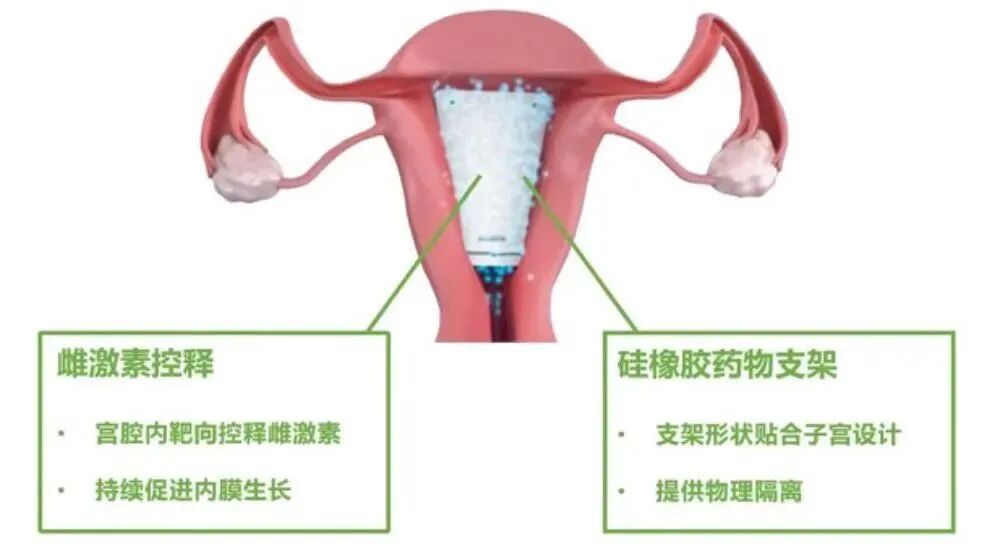 子宫支架怎么上【技术前沿】全市首例！市妇幼保健院成功实施硅橡胶子宫药物支架植入术，为不孕患者点亮“生”机_https://www.jmylbn.com_新闻资讯_第10张