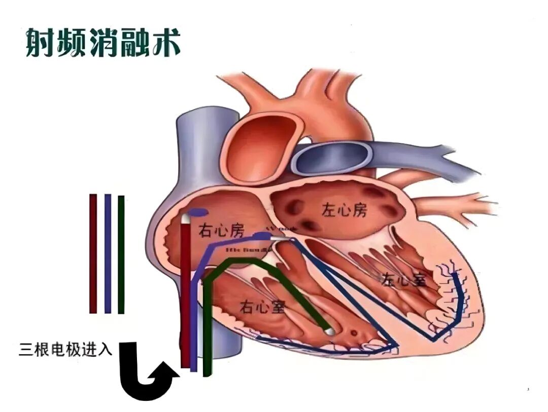 心电图机怎么修精准维修”重获“心”生 ｜ 永城市胸痛中心成功救治56岁心跳“飙车”大叔！_https://www.jmylbn.com_新闻资讯_第17张