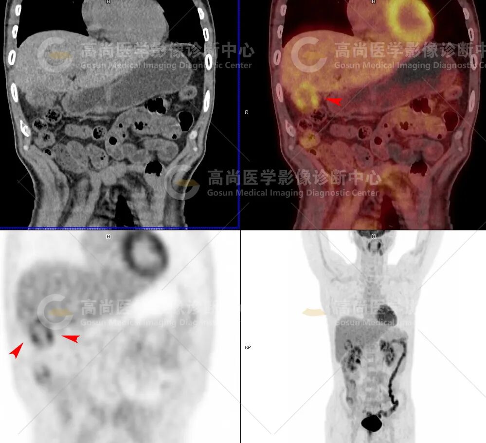 【高尚病例】患者体重下降、黄疸，PET/CT 协诊黄色肉芽肿性胆囊炎