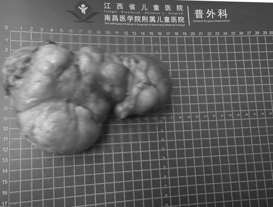 半岁宝宝反复咳体内取出17厘米巨瘤