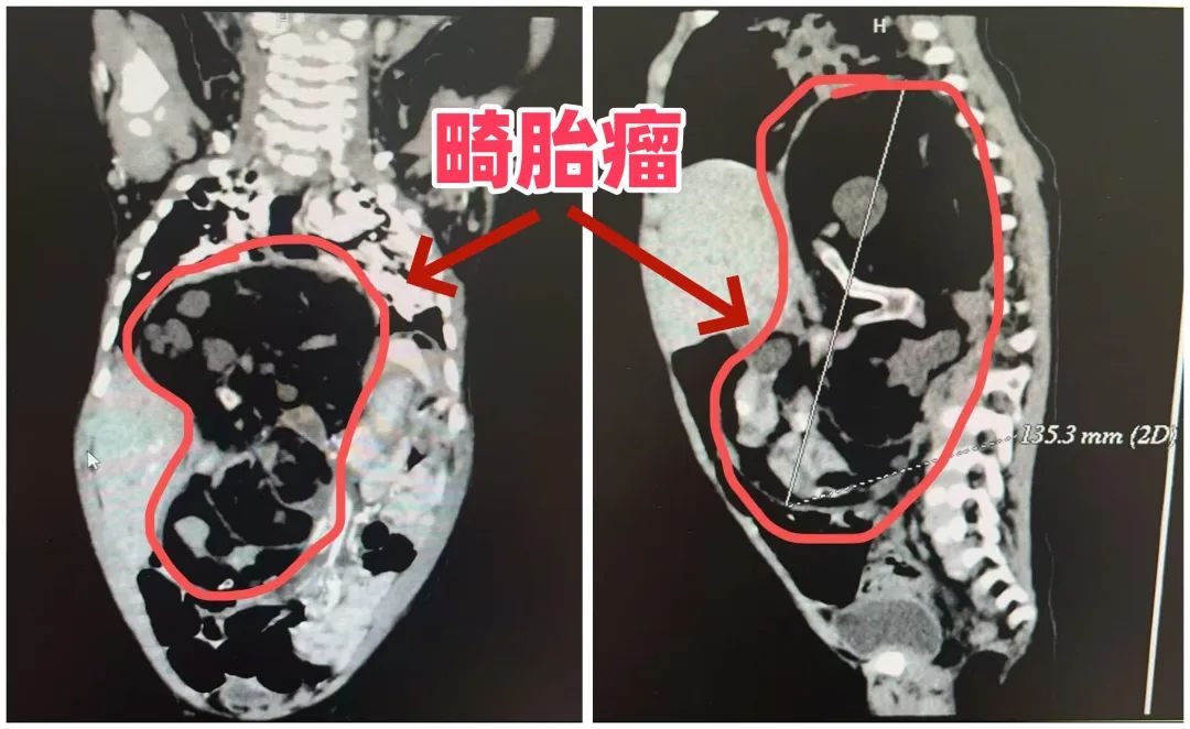半岁宝宝反复咳体内取出17厘米巨瘤