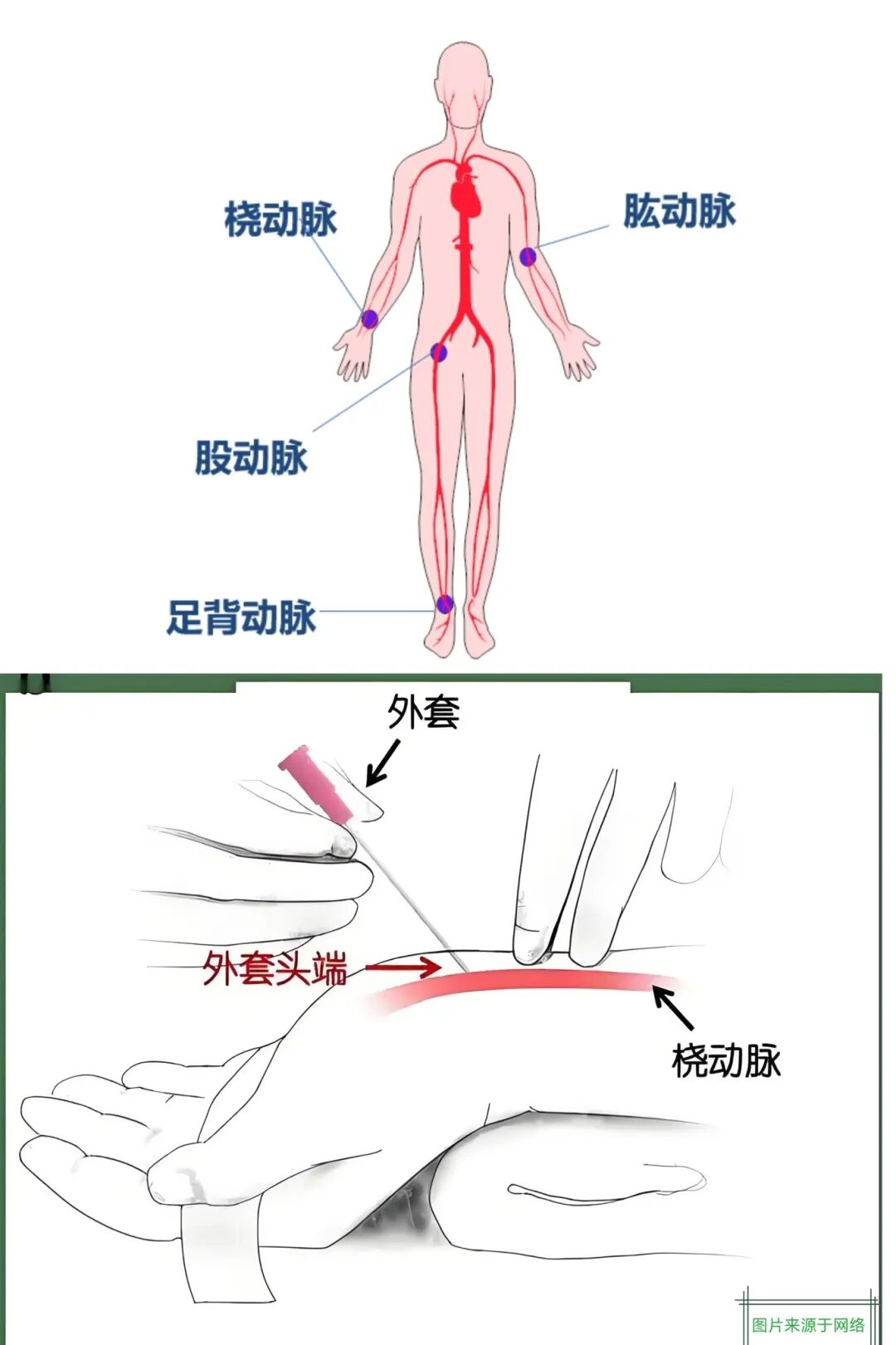 动脉留置针怎么拔做手术为啥要把留置针扎到动脉里？答案在这里_https://www.jmylbn.com_新闻资讯_第2张