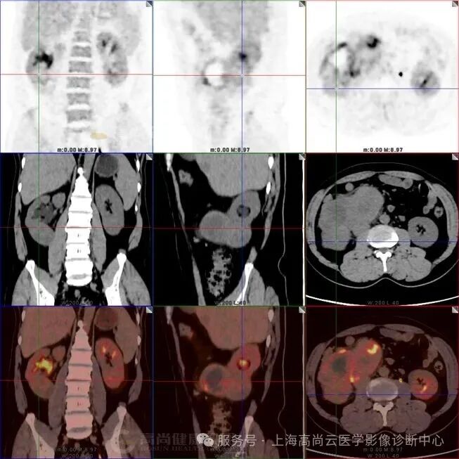 【高尚病例】腹中见雷——巨大脂肪肉瘤的 PET/CT 影像