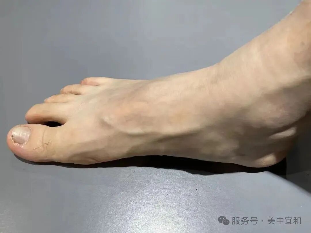 专家说｜孙宁主任教你：𧿹外翻术前康复训练，常做的 4 个动作！