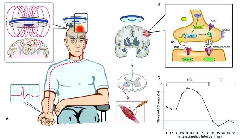 tms什么医疗重焕大脑机能之光！这项康复治疗黑科技，是时候了解下了！_https://www.jmylbn.com_新闻资讯_第9张