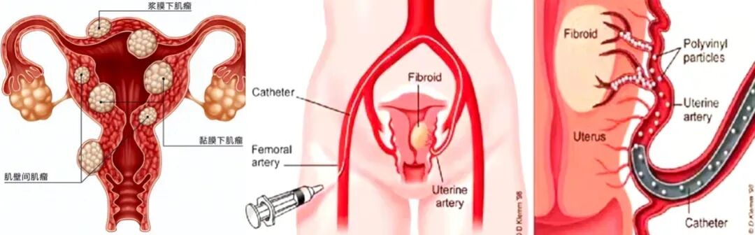 为什么要用到微导管济医附院成功开展“无鞘微导管技术”治疗子宫肌瘤_https://www.jmylbn.com_新闻资讯_第2张