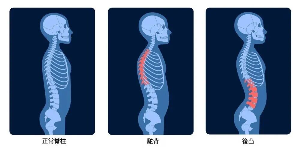 禁止挺胸夹背,圆肩驼背时不要盲目过度的挺胸和夹紧肩胛骨