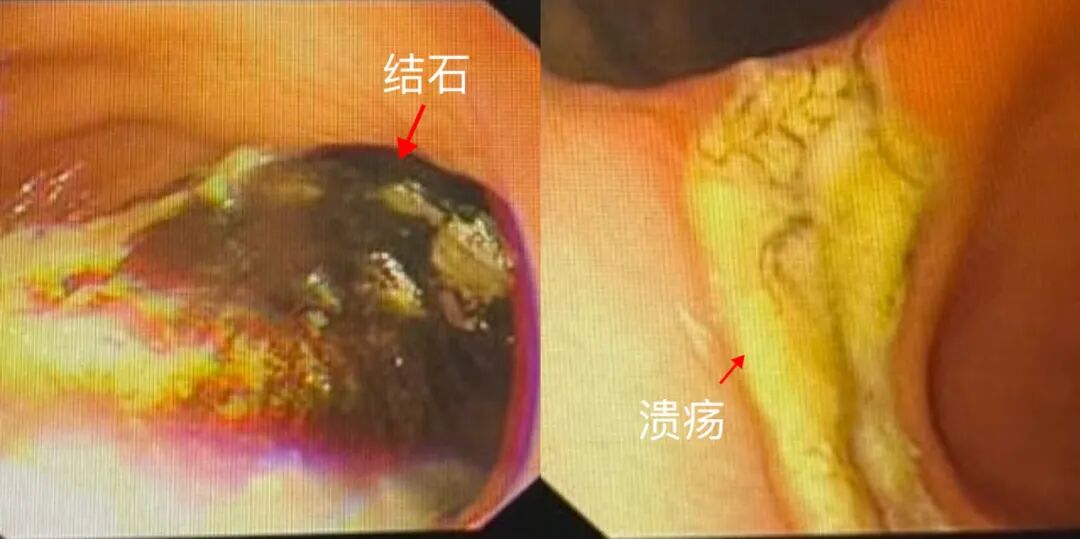 胃镜下检查：棕色的是结石，白色的是溃疡.JPG