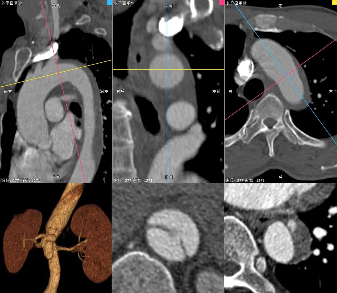 泥鳅导丝怎么用郎德海、胡松杰教授团队：浙江省首例使用0.035″泥鳅导丝软头柔性破壁原位重建LSA_https://www.jmylbn.com_新闻资讯_第5张