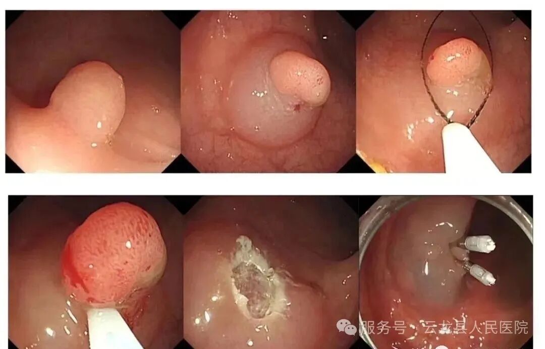 肠镜检查怎么做