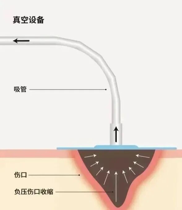 vsd引流怎么拔出VSD负压引流术，助压疮患者摆脱痛苦_https://www.jmylbn.com_新闻资讯_第3张