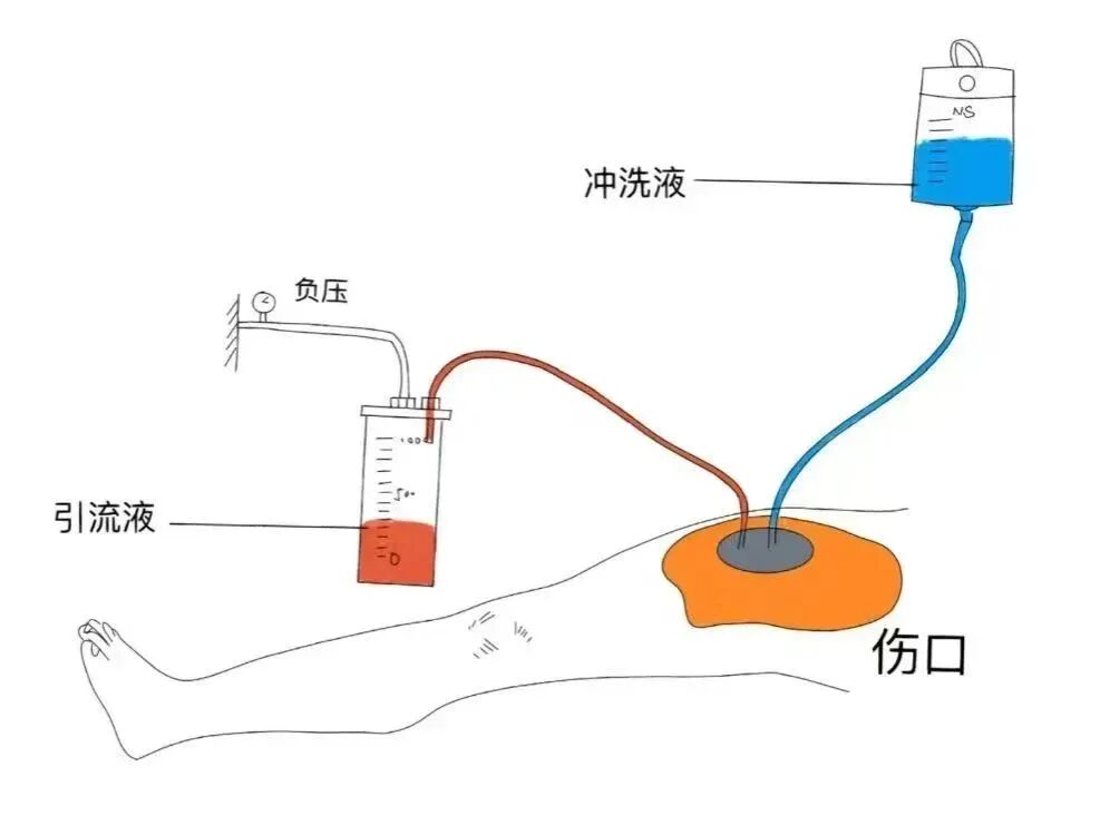 vsd引流怎么拔出VSD负压引流术，助压疮患者摆脱痛苦_https://www.jmylbn.com_新闻资讯_第4张