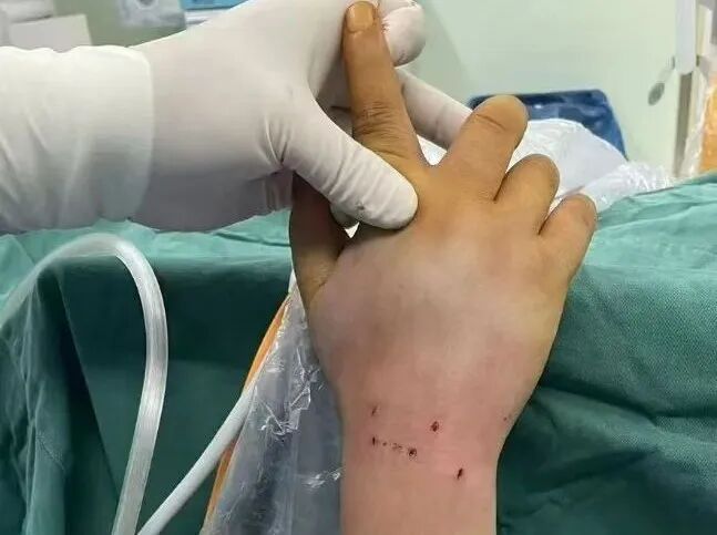 手术电钻怎么用电锯电钻抡大锤，骨科手术蛮怕人？很多专家早就转型玩“针线活”了_https://www.jmylbn.com_新闻资讯_第15张