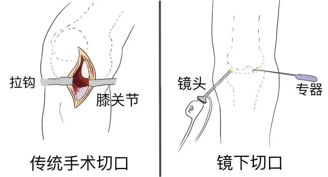 手术电钻怎么用电锯电钻抡大锤，骨科手术蛮怕人？很多专家早就转型玩“针线活”了_https://www.jmylbn.com_新闻资讯_第11张