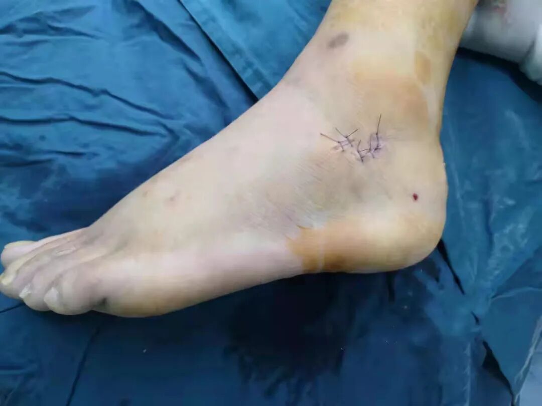 手术电钻怎么用电锯电钻抡大锤，骨科手术蛮怕人？很多专家早就转型玩“针线活”了_https://www.jmylbn.com_新闻资讯_第12张