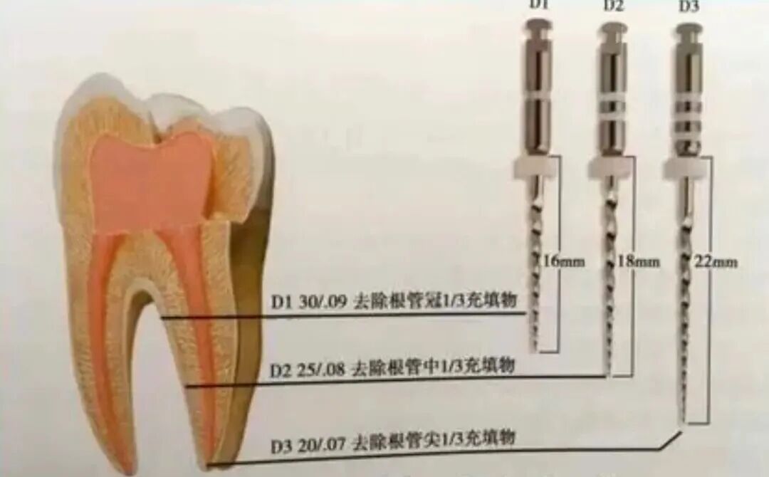 处理根管再治疗时，牙胶取出的常规操作