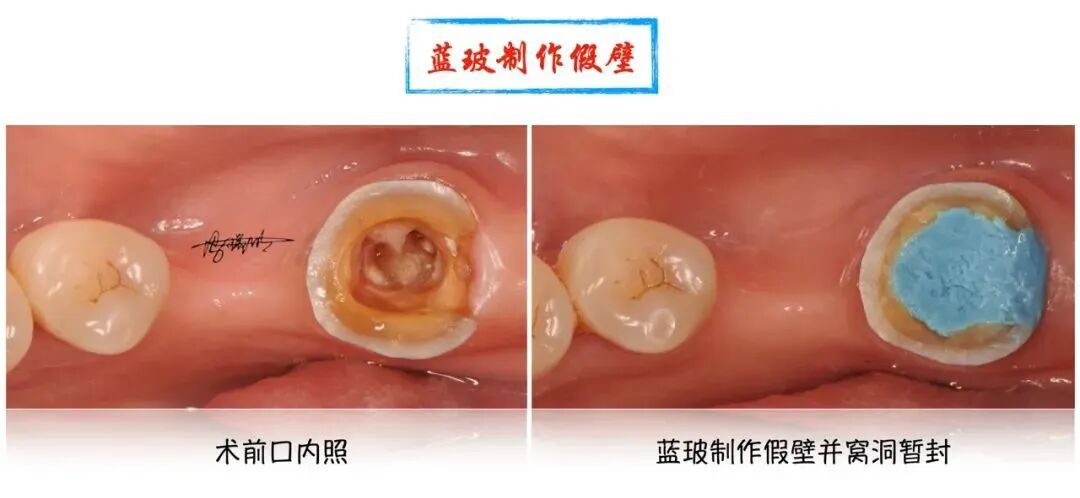 蓝玻在根管治疗中的应用
