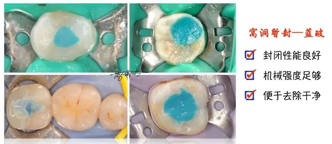 蓝玻在根管治疗中的应用