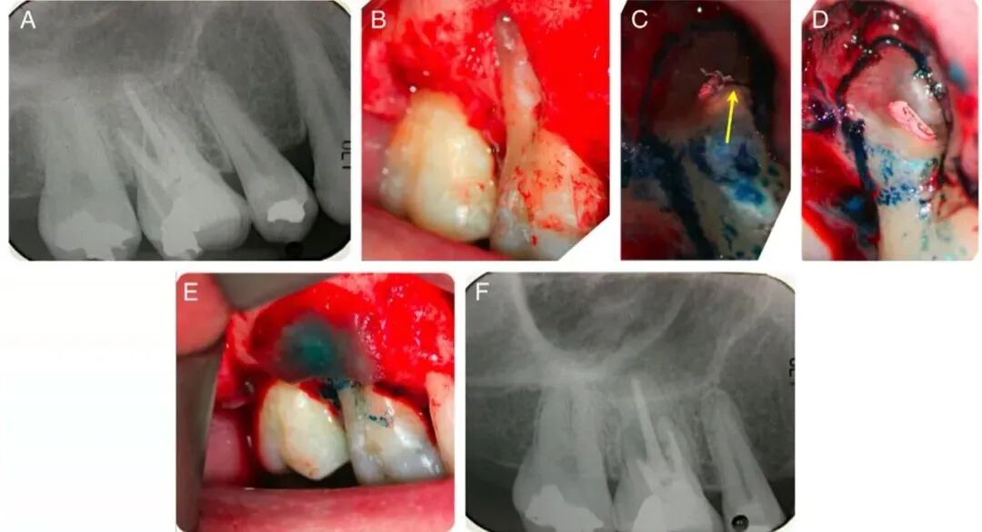蓝玻在根管治疗中的应用