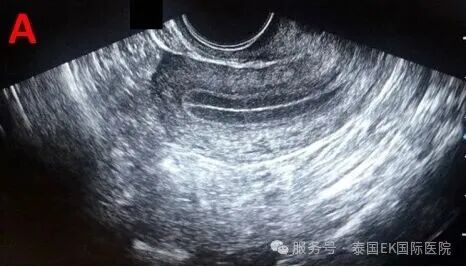 泰国EKI-IVF冷冻胚胎移植人工周期取消的常见原因