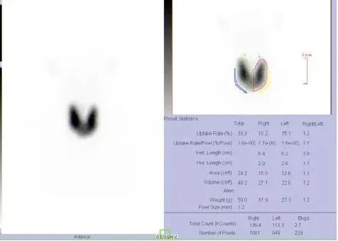 d-spect怎么检查【科普先锋】甲状腺也有“冷”和“热”？核医学的SPECT检查告诉你答案_https://www.jmylbn.com_新闻资讯_第4张