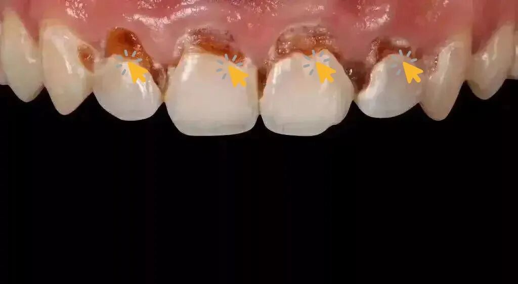 珠海牙科——什麼是牙酸蝕症？_常見問題_牙齒美白_珠海牙科種植牙-珠海箍牙-維港口腔連鎖珠海分院官網-珠海牙科種植牙-珠海箍牙-維港口腔連鎖珠海分院官網