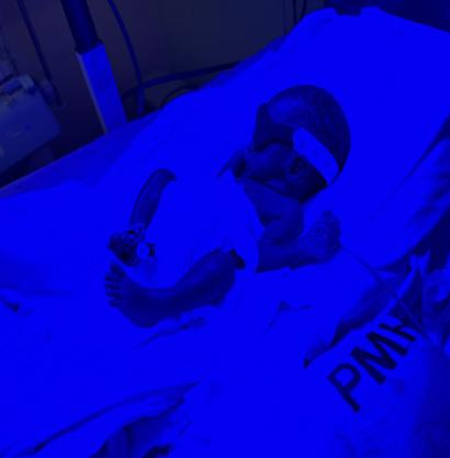 光疗时为什么黑眼罩【妇幼人文】巧手以柔光 暖护新生眸│援外护士用冲锋衣爆改护眼罩_https://www.jmylbn.com_新闻资讯_第9张